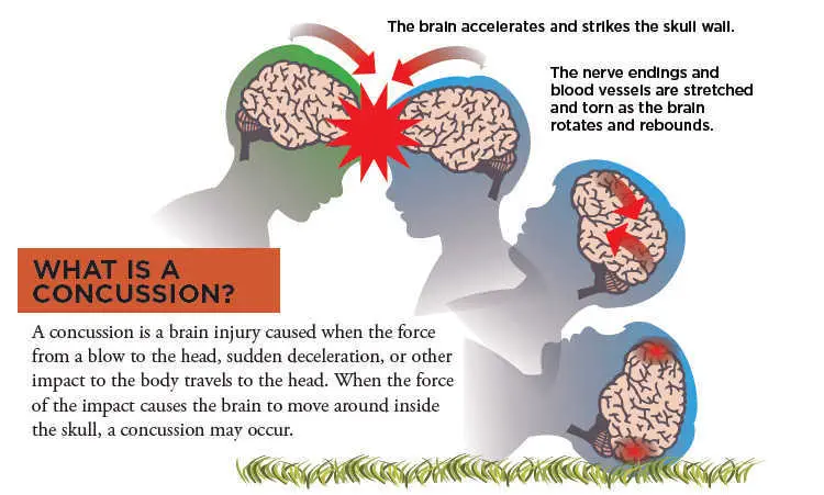 homeopathy for concussions